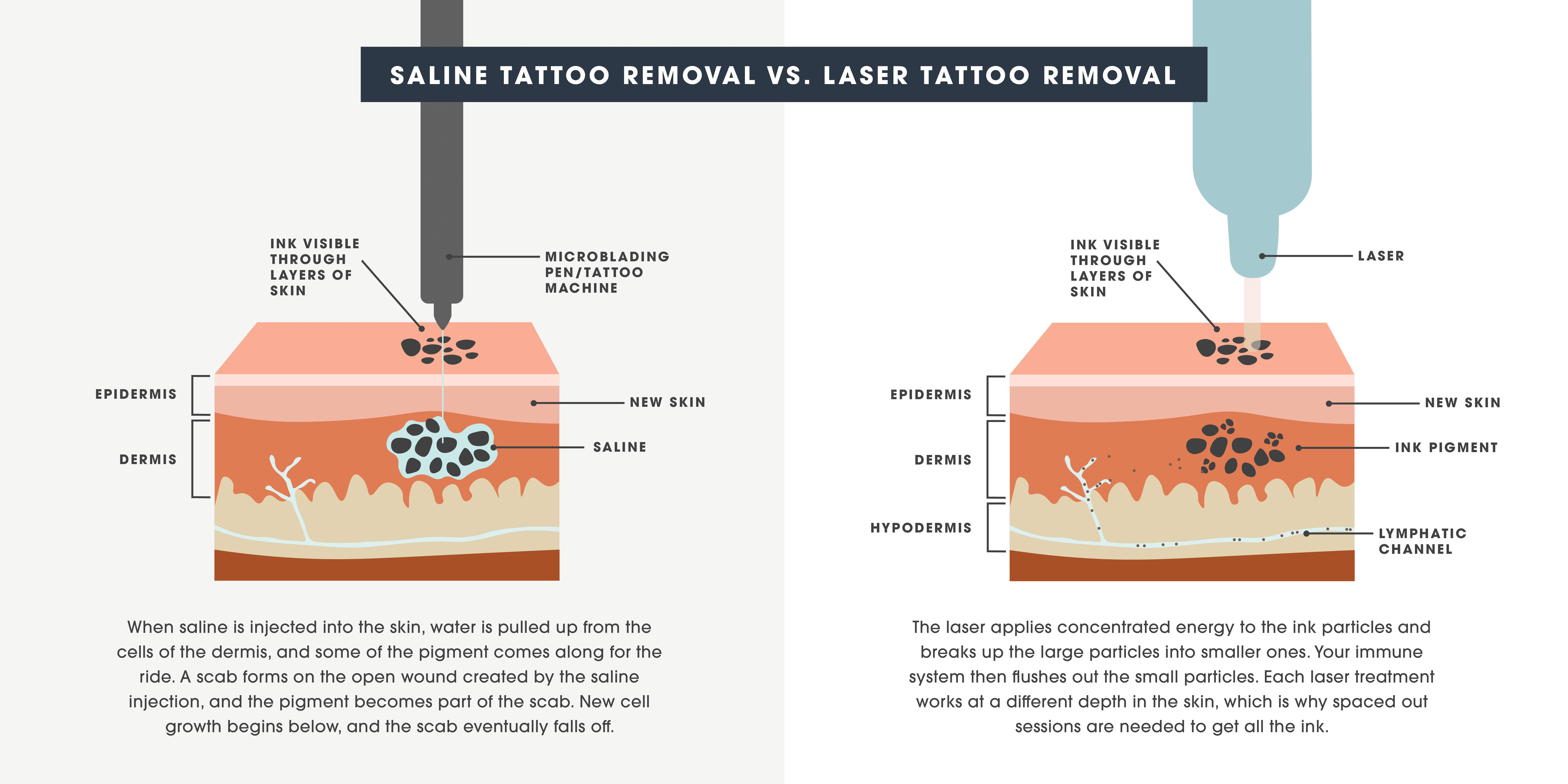 Brow Tattoo Removal Laser Vs Saline Removal Vs Correction