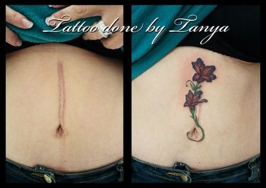 Can You Tattoo Keloid Scars Julee Burgos