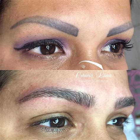 Eyebrow Laser Tattoo Removal