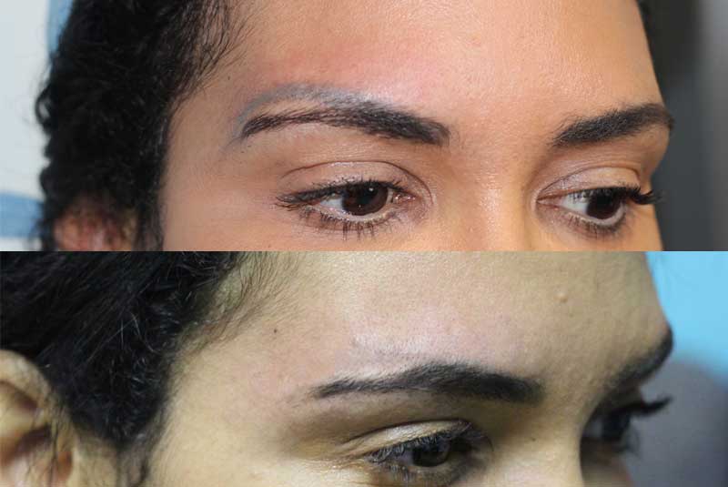 Tattoo Removal for Eyebrows: A Safe and Effective Solution