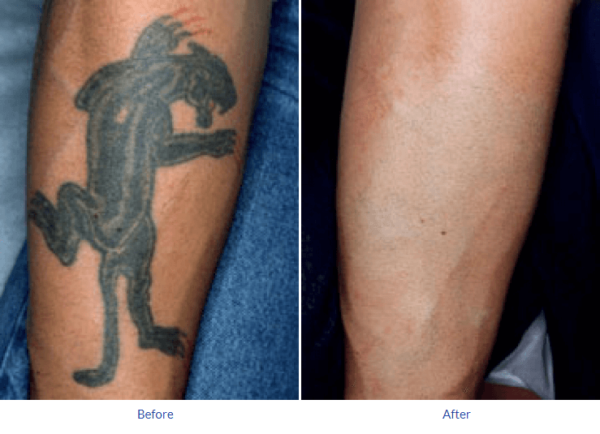 How Much Tattoo Removal Cost Tattoos