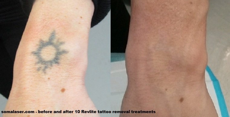 Laser Tattoo Removal Before After Photos Birmingham