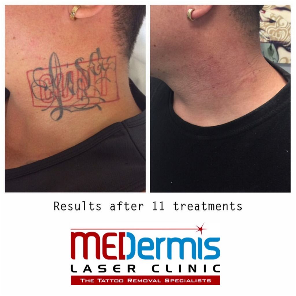 Laser Tattoo Removal Costs And Clinics Near Me