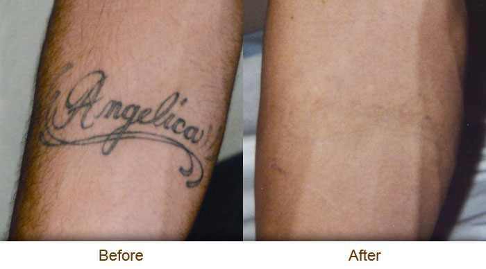 5 Ways to Afford Tattoo Removal Costs