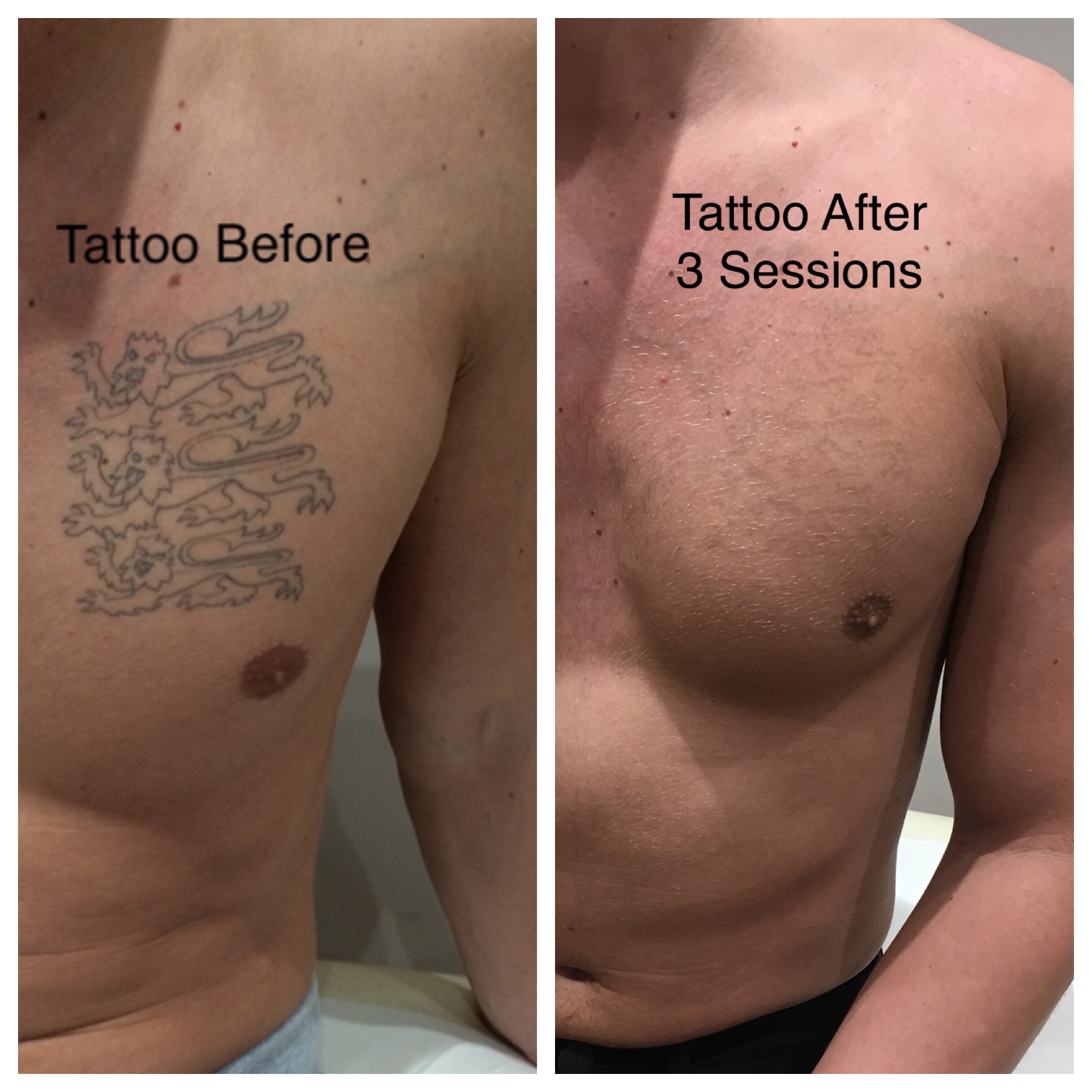 Removing A Tattoo How Much Does Tattoo Removal Cost Tatto Remove