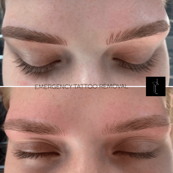 Saline Eyebrow Tattoo Removal Before And After When Is It Better