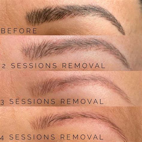 Saline Eyebrow Tattoo Removal