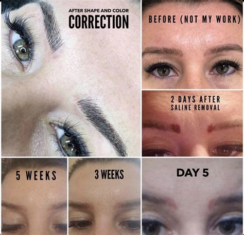 Saline Removal Permanent Makeup Tattoo Removal Tattoo Removal Glow Artistry White Rock British Columbia