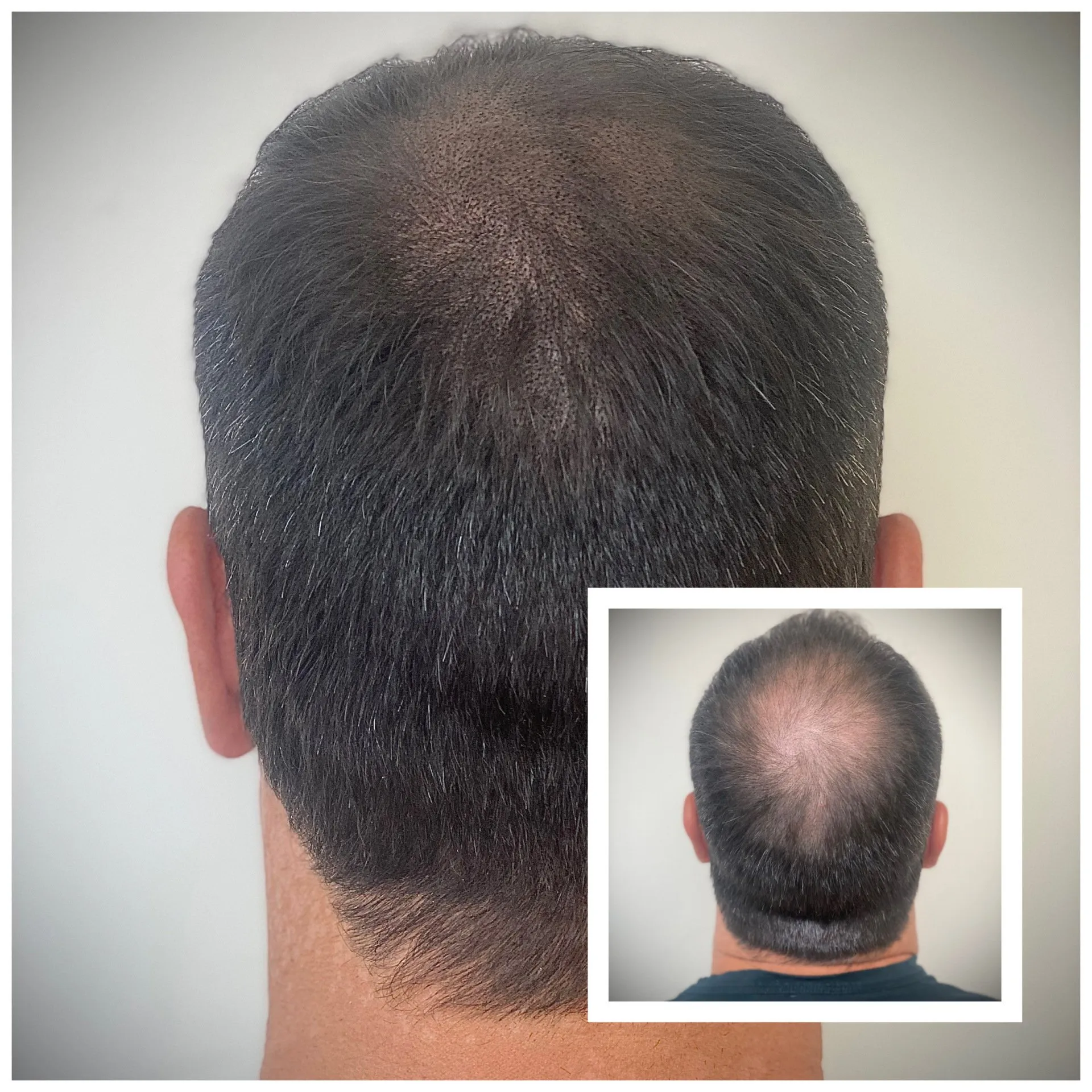 Scalp Micropigmentation Smp For Long Hair Life Changing Density Boost