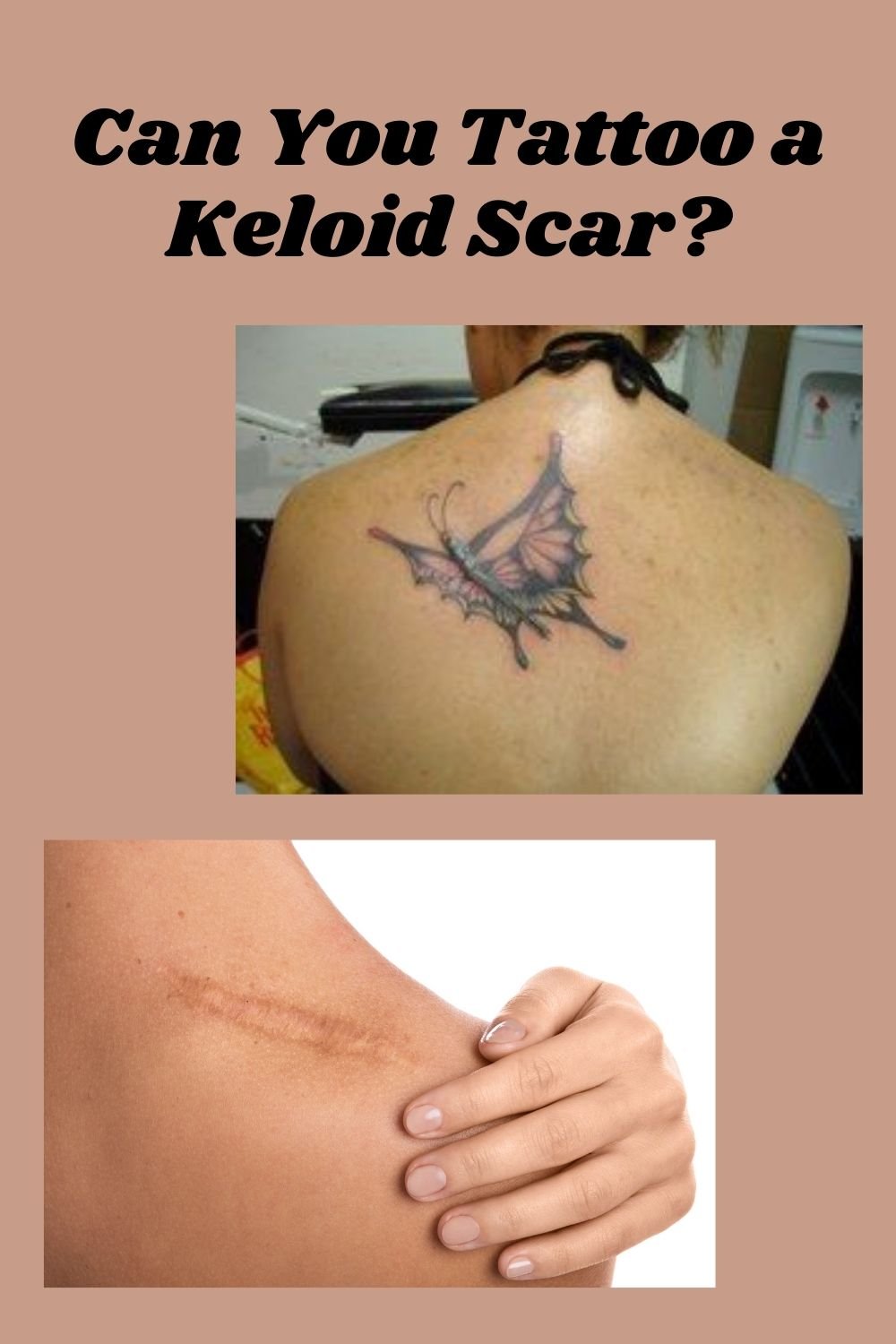 Tattoo Covering The Keloid Scar Youtube