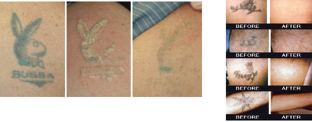 Tattoo Removal Cost And Tattoo Removal Size Guide Removery