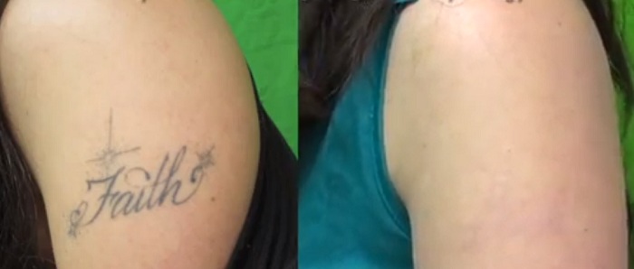 Tattoo Removal Dermatology And Laser Centre Of Los Angeles