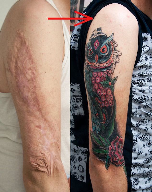 Tattoos Over Scars: Transforming Imperfections into Art