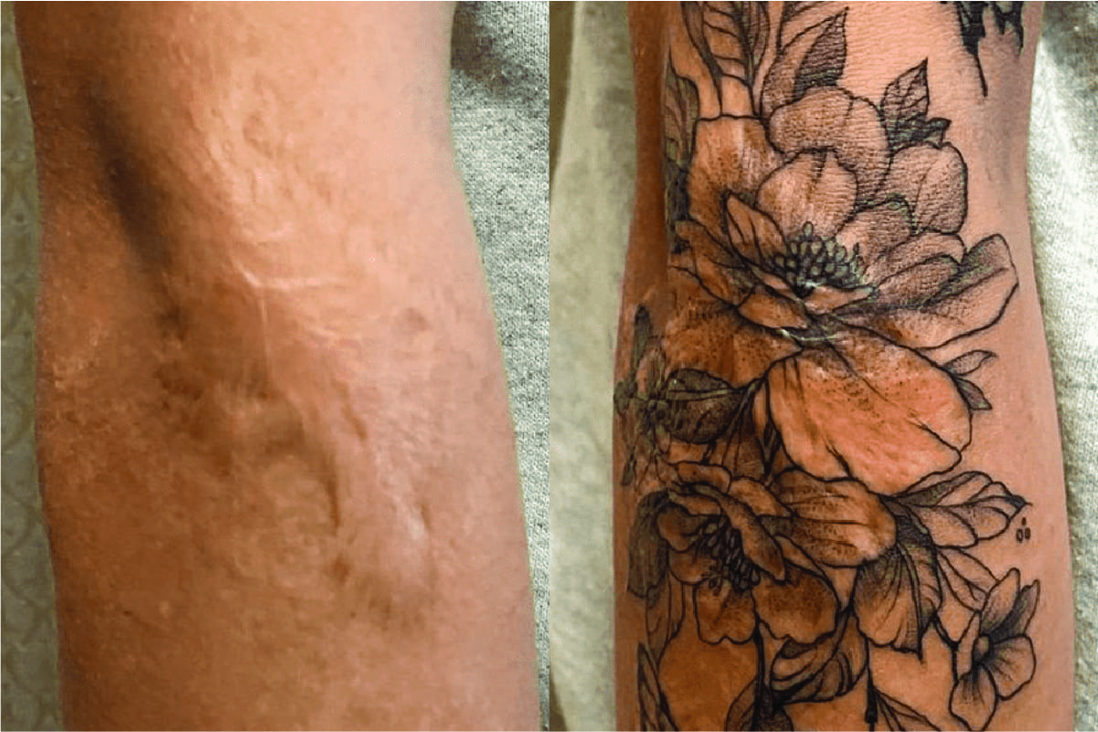 Top More Than 79 Tattoos To Cover Scars On Legs In Eteachers